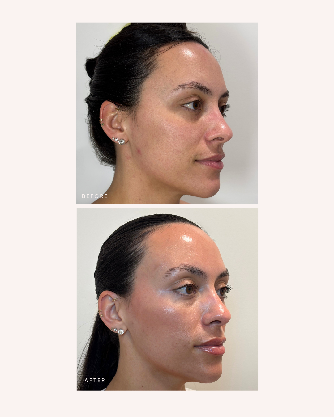 attune med spa westport ct Full Face Botox + Lip Filler