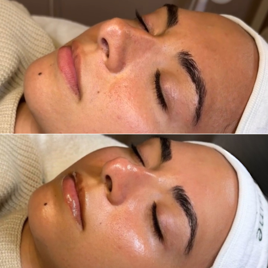 Results from a Hydrafacial™