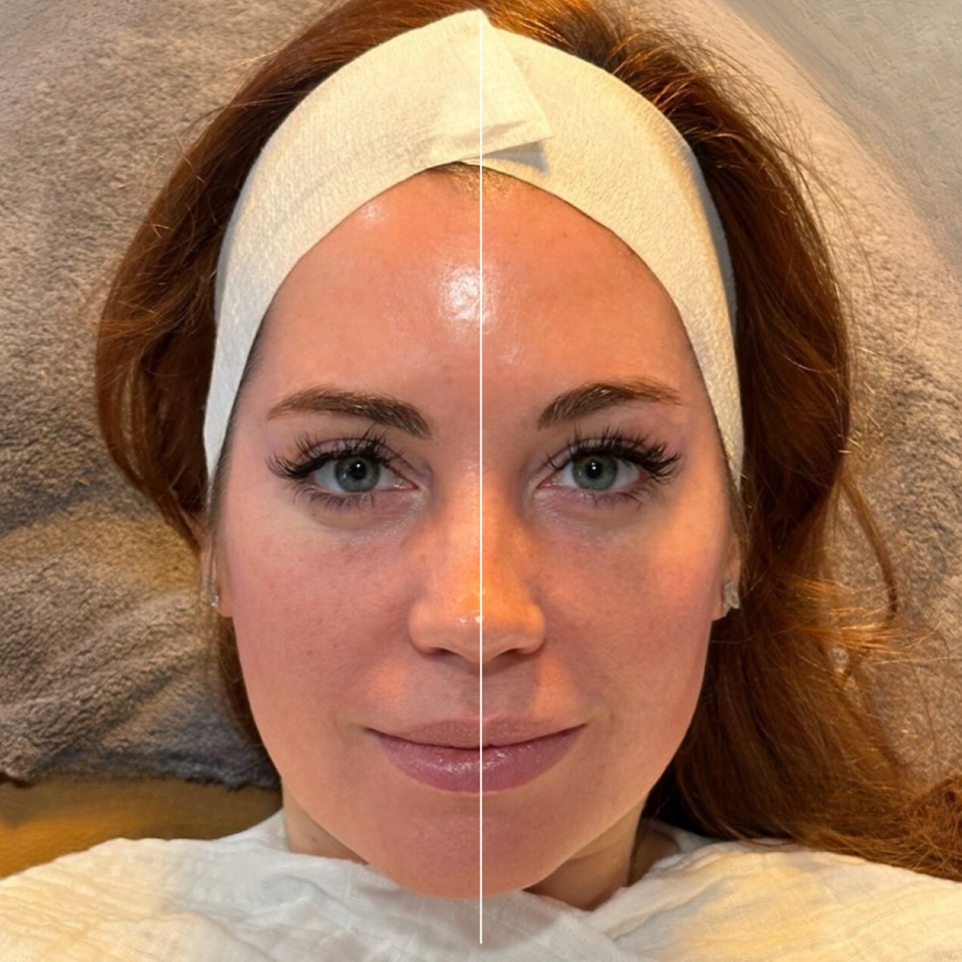 Results from the Attune Detox Facial